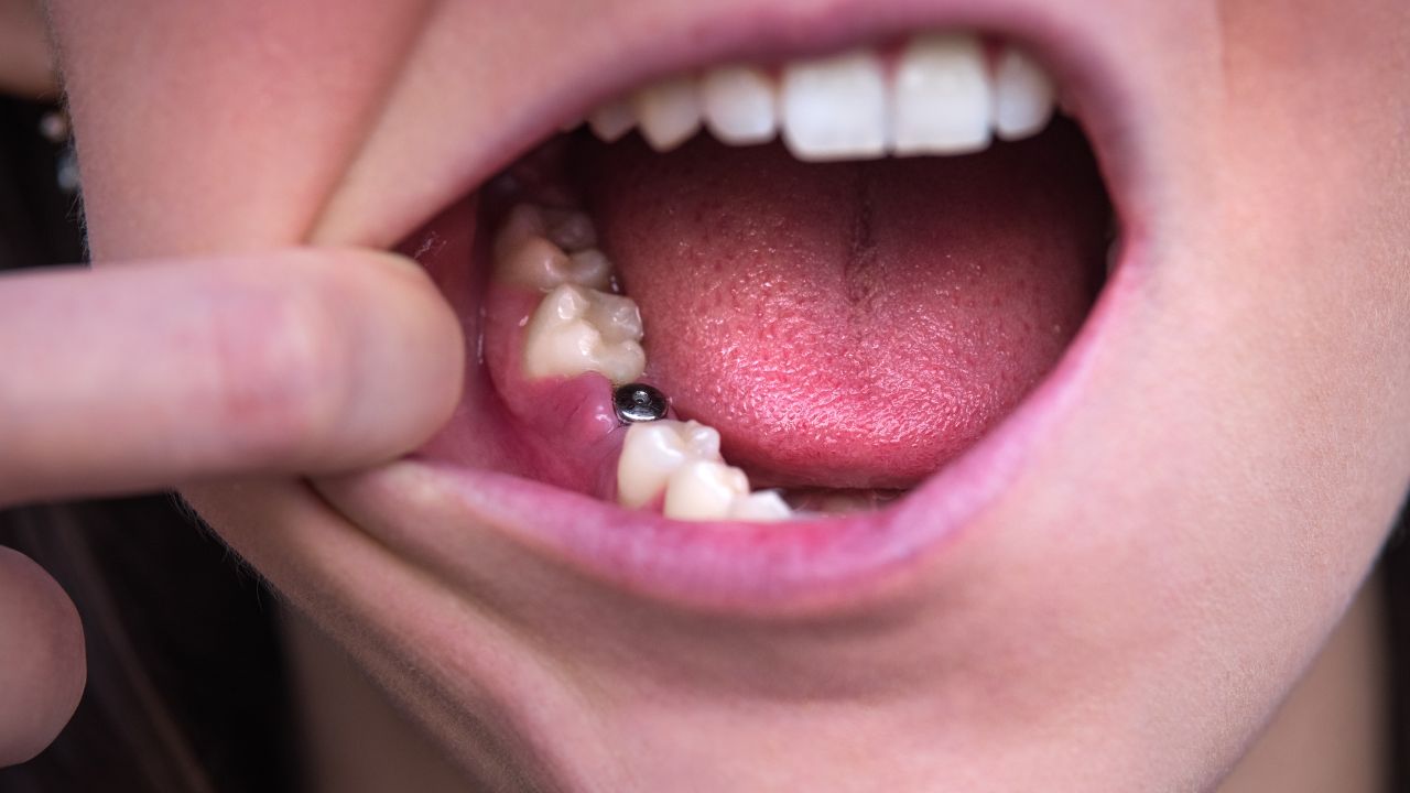 Traumdeutung Zähne fallen aus » ASTOUNDED Old School Radio